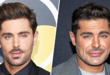 Zac Efron Face Surgery